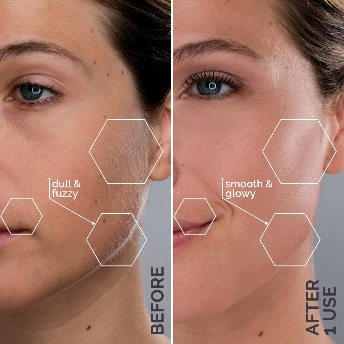 2 Month Supply . Side-by-side comparison of a woman's face showing "Before" and "After Use" results, highlighting improvements in skin texture from "dull & fuzzy" to "smooth & glowy," thanks to the precision of Michael Todd Beauty's Sonicsmooth Clear Refill Tips.