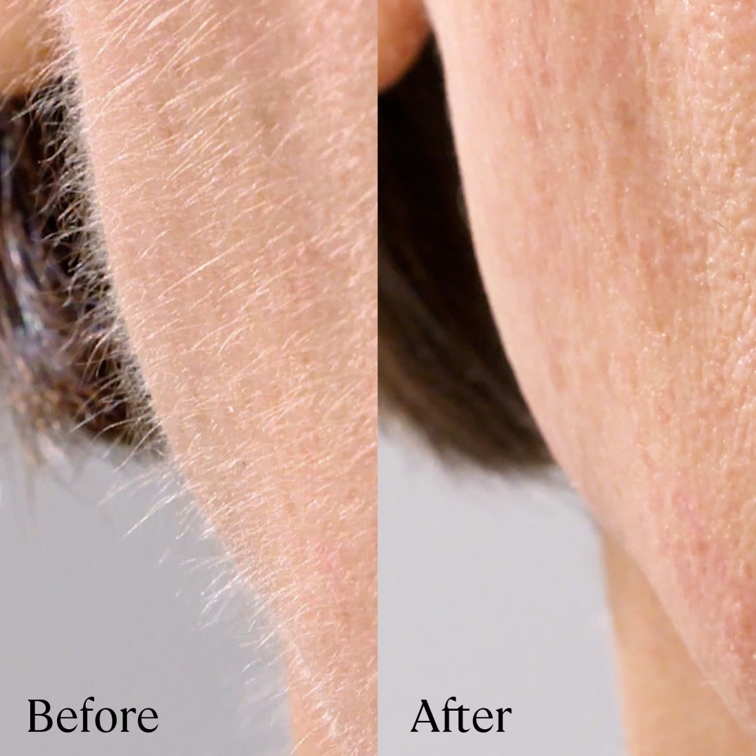 4 Month Supply - Close-up photo of a skin area on the left side labeled "Before" showing more prominent facial hair compared to the right side labeled "After" with reduced facial hair, achieved using Michael Todd Beauty's Sonicsmooth Clear Refill Tips.