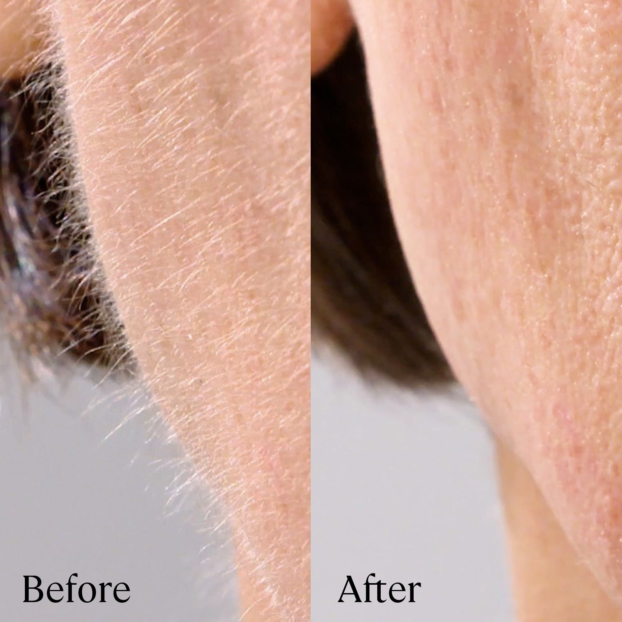 1 Set Sonicsmooth Pro+ Replacements Safety Tips + Microdermabrasion Tips